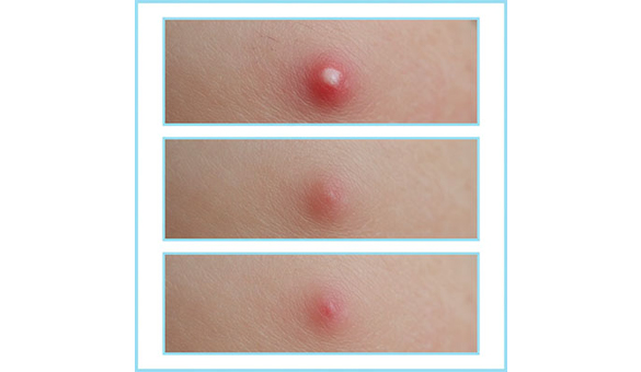 What Kills Acne Quickly? Fast-Acting Solutions That Actually Work