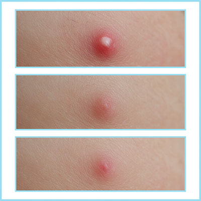 Quick acne treatment showing rapid reduction in pimple size and redness within 24 hours